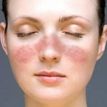 Primul ghid scris de pacienții din România despre viața cu Lupus - o „boală cu o sută de fețe”